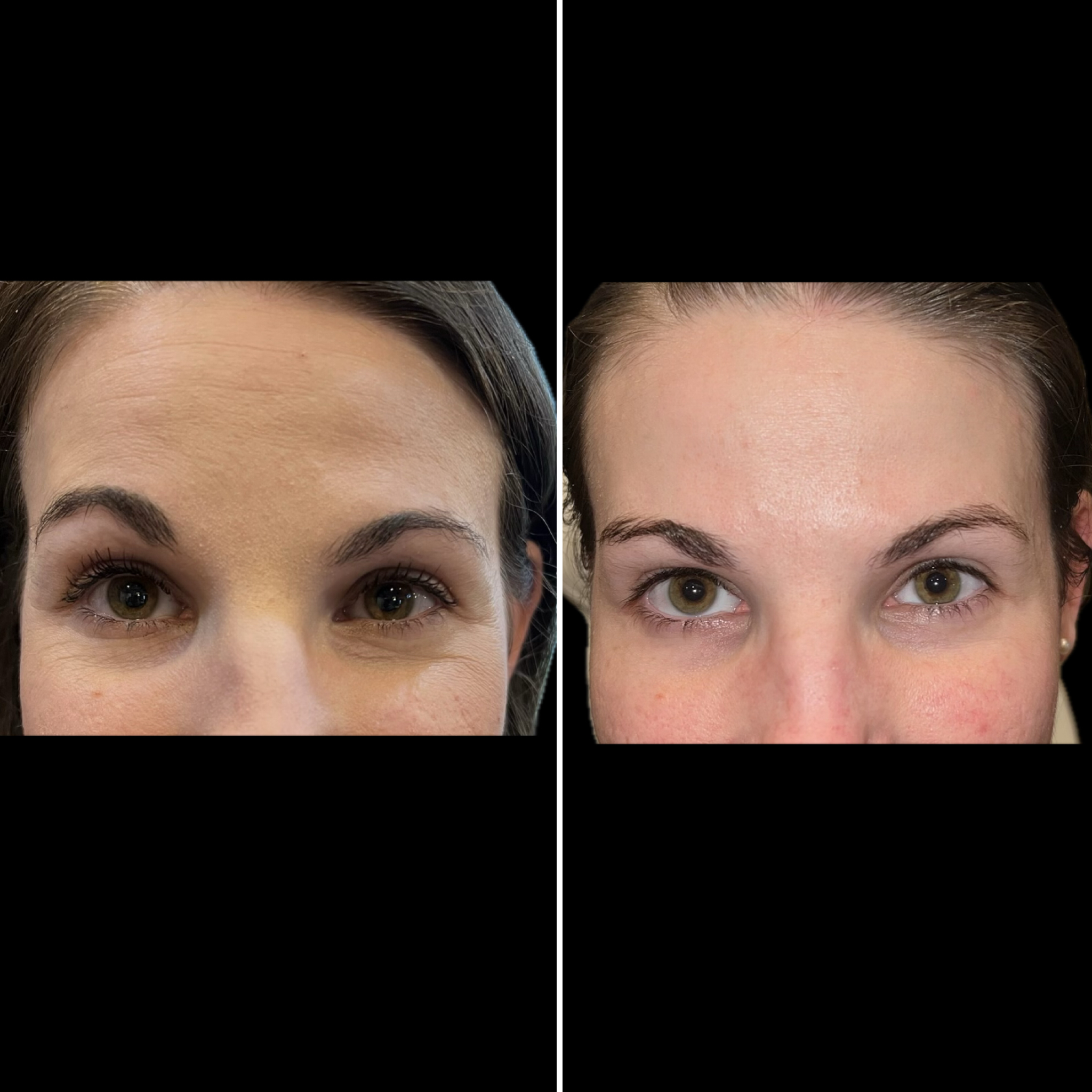 Before and After Image: Brow Asymmetry correction with botox - front