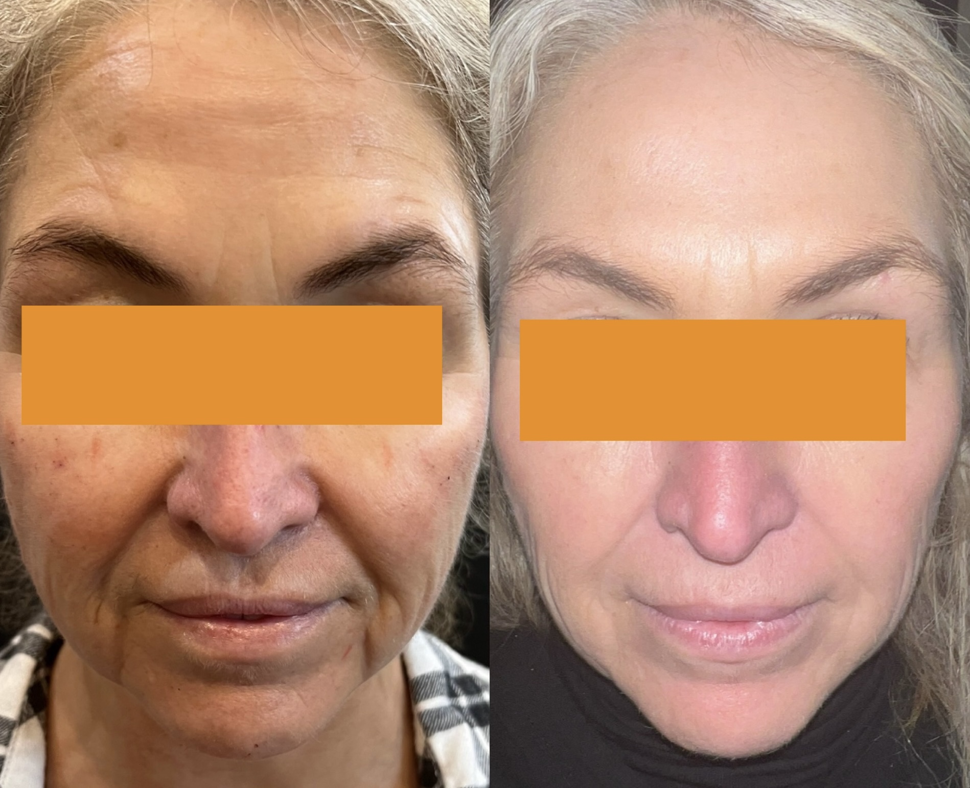 Before and After Image: Full face balancing Botox, PDO Threads, Juvederm Filler, HydraFacial - front